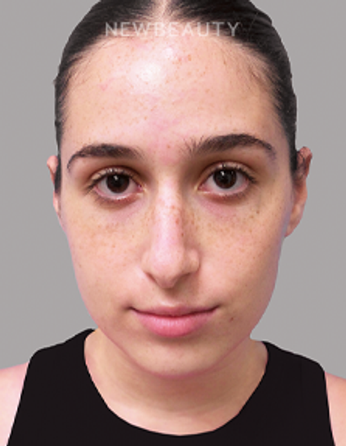 Dr. Michael A. Epstein - Natural-Looking Results - 33109401 - Before