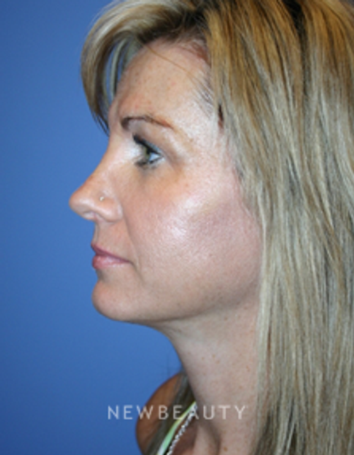 Dr. Kelly Bomer-Rhinoplasty - After