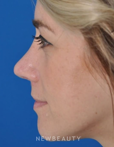 Dr. Edward Kwak - Revision Rhinoplasty - After