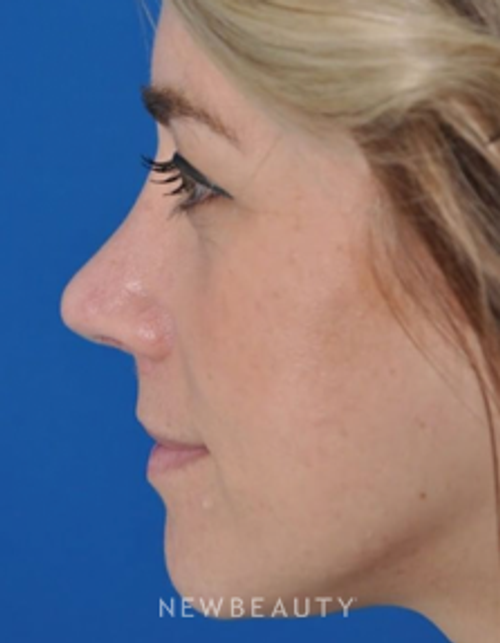 Dr. Edward Kwak - Revision Rhinoplasty - After