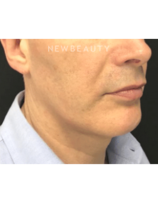 Dr. Julie Russak - Kybella - After