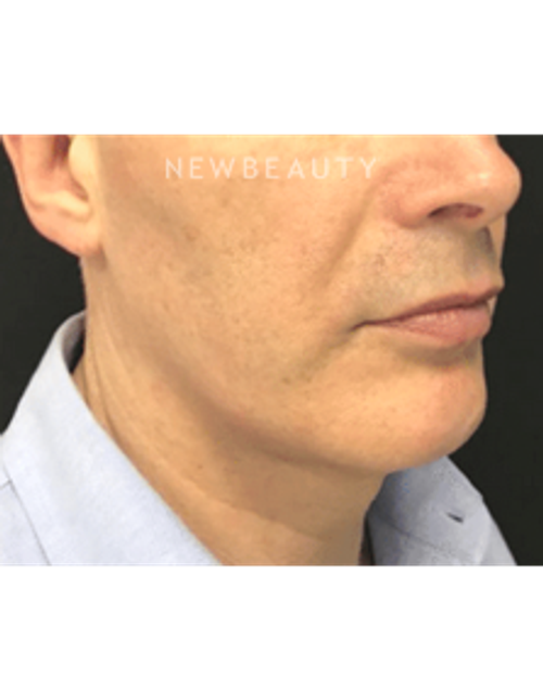 Dr. Julie Russak - Kybella - After