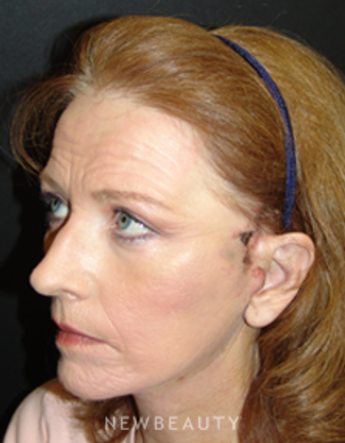 Dr. Mokhtar Asaadi Eyelid Lift, Facelift, Necklift - After