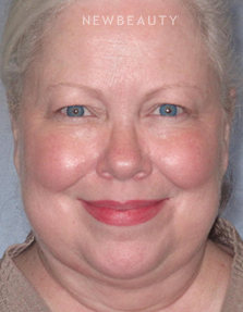 Dr. Henry Mentz III - An Award-Winning Facelift - Before