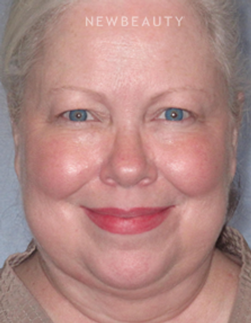 Dr. Henry Mentz III - An Award-Winning Facelift - Before