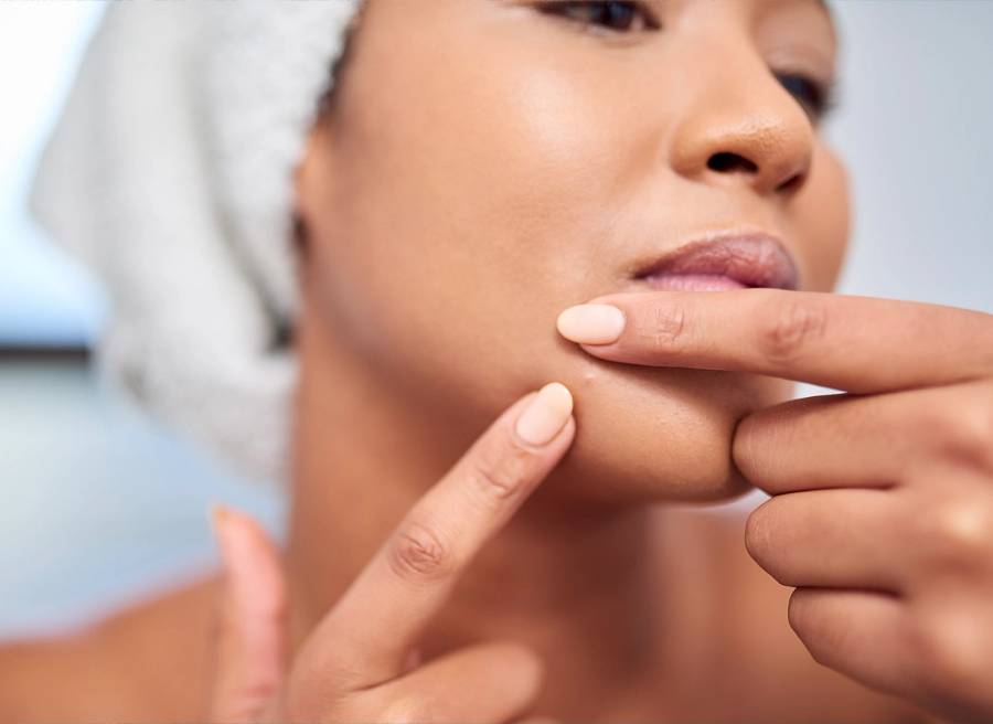 Chin Acne: Experts Reveal the Top Culprits