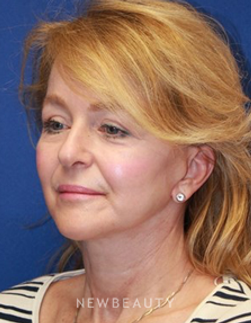 Dr. Dillip D. Madnani - Revision Necklift with Fat Transfer - After