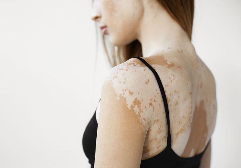 Everything to Know About Vitiligo, Including How to Best Treat It