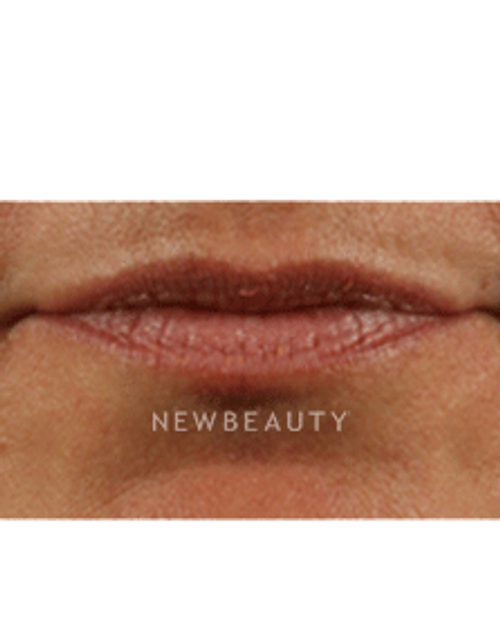 Dr. Marina Peredo Lip Augmentation - Before