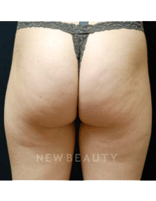 Dr. Kenneth Beer Smoothshapes - Before