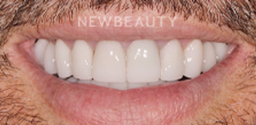Dr. Salvator La Mastra - Smile Makeover -46106635 - After