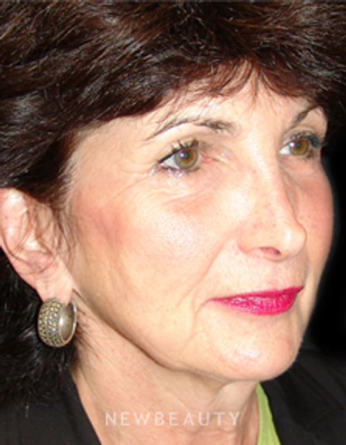 Dr. Mokhtar Asaadi Eyelid Lift, Facelift, Necklift - Before