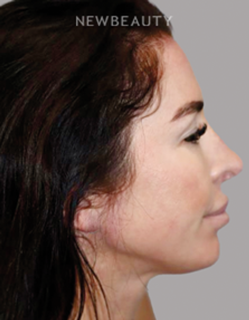Dr. Sanjay Grover - Rhinoplasty - 49727947 - After