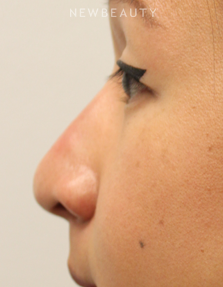 Dr. Kimberly Lee - Non-Surgical Rhinoplasty - After