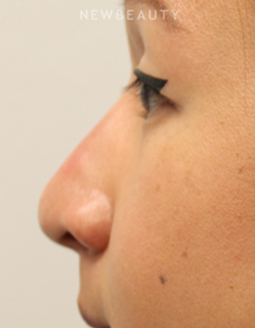 Dr. Kimberly Lee - Non-Surgical Rhinoplasty - After