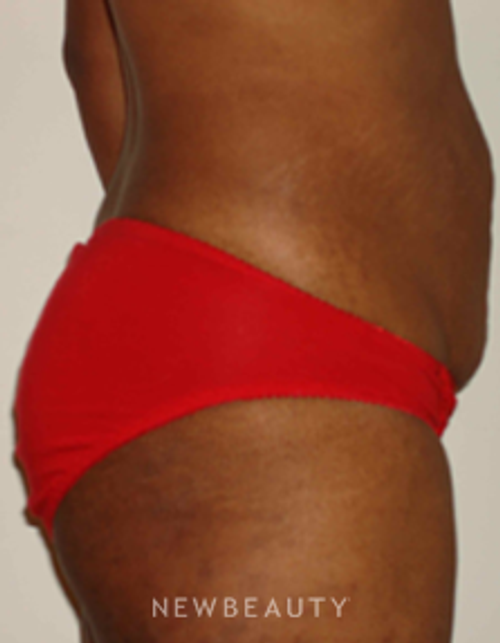 Dr. Michael Horn Tummy Tuck - Before