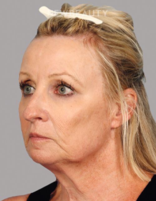 Dr. Mahabir - Facelift - 20637984 - Before