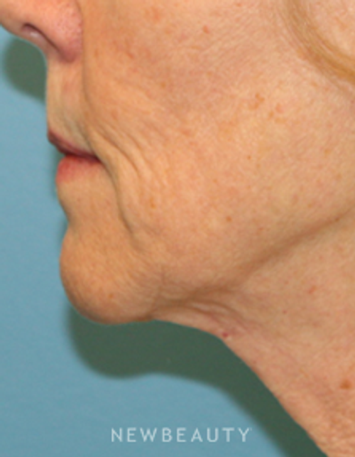 Dr. Christine Hamori - Facelift - Before