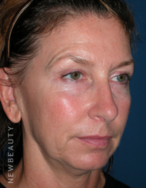Dr. Adam Summers Chin Liposuction, Smart Facelift - Before