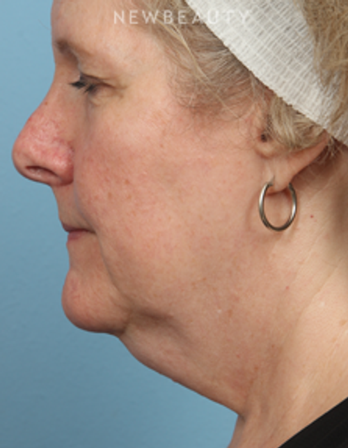 Dr. Kathleen Behr - CoolSculpting - Before