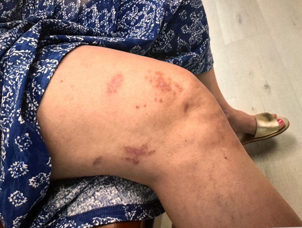 photosensitive skin ras