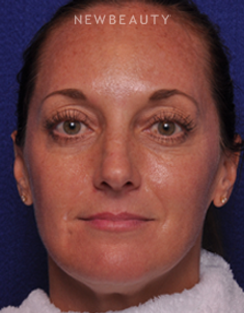 Dr. Alan J. Durkin - Injectables and Fillers - Before