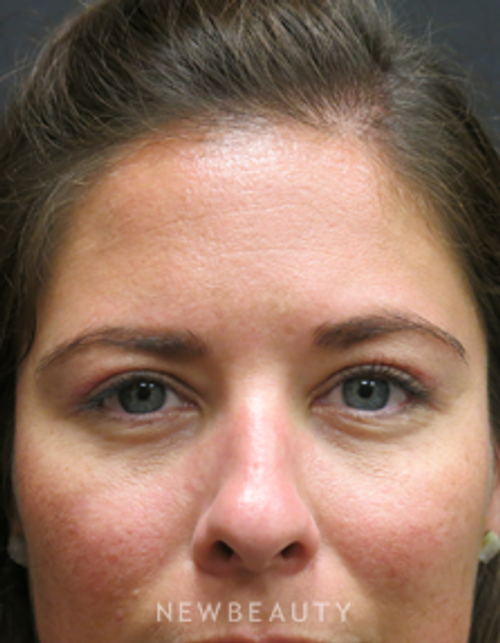 Dr. Elie Levine - Upper Blepharoplasty - After