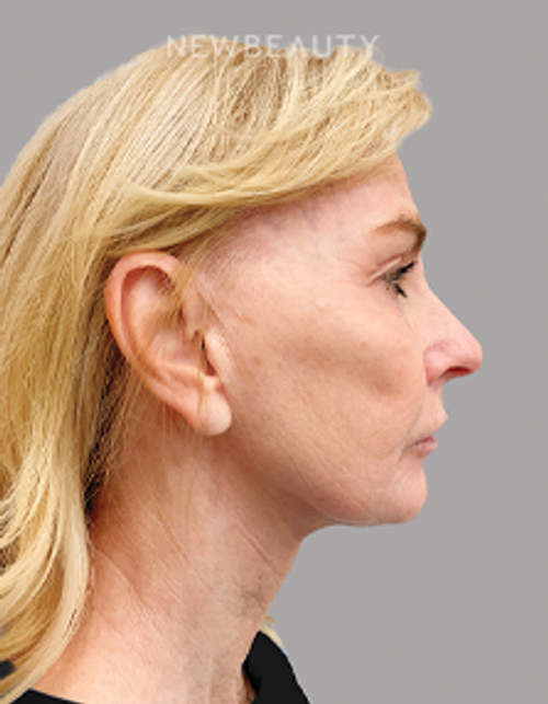 Dr. Joel Schlessinger – Botox, Injectables And Fillers and Lasers – 53105442 - Before