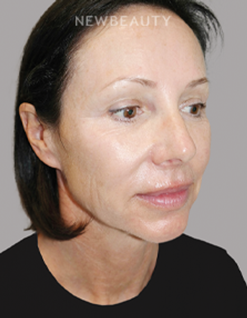Dr. Sanjay Grover - Facelift - 49726325 - Before