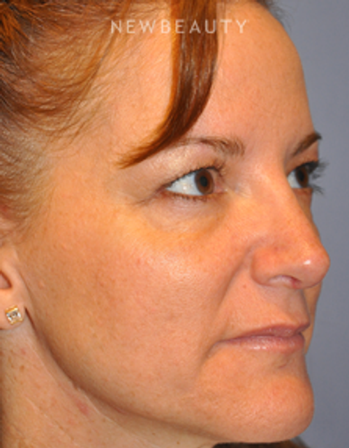 Dr. Bryan W. Gawley - Revision Rhinoplasty - After