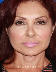 Dr. Konstantin Vasyukevich- Facelift - After