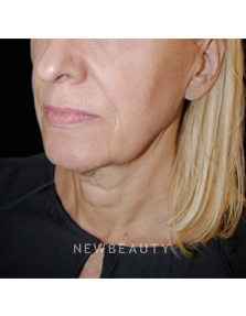 Dr. Lee Ann M. Klausner - Skin Rejuvenation - Before