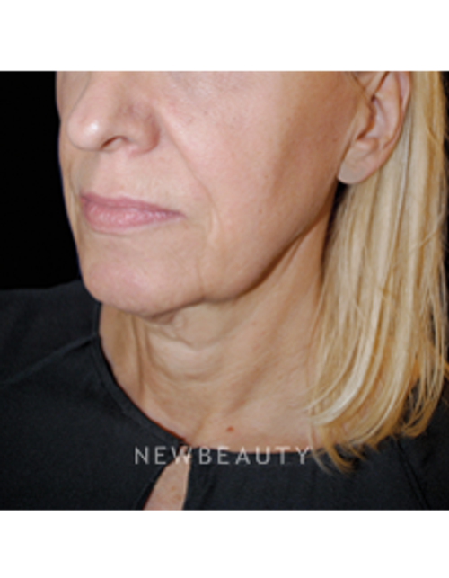 Dr. Lee Ann M. Klausner - Skin Rejuvenation - Before