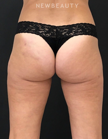 Dr. Janet Allenby - EmSculpt - After