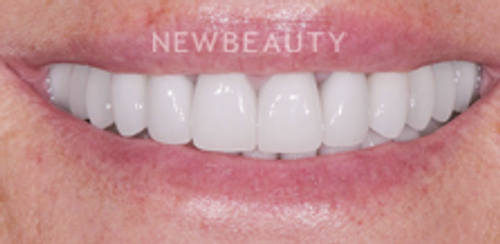 Dr. Salvator La Mastra - Smile Makeover - 46106681 - After