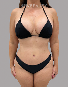 Dr. Daniel Crane – Mommy Makeover - 46166444 - After