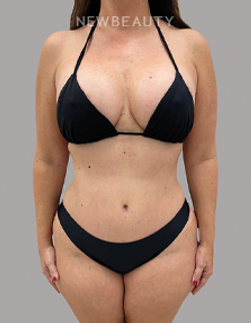 Dr. Daniel Crane – Mommy Makeover - 46166444 - After