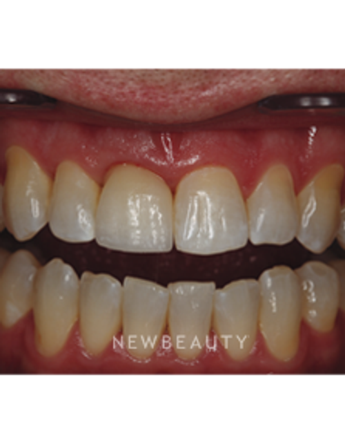 Dr. Neal Patel - Dental Implant - After