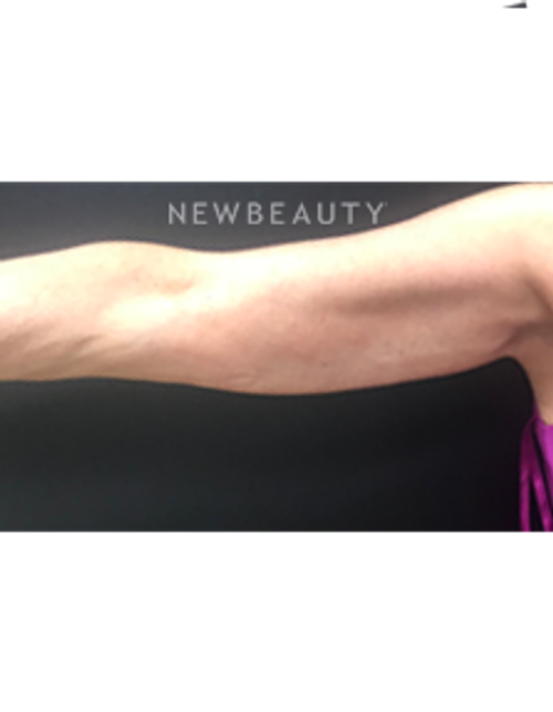 Dr. Mokhtar Asaadi - Arm Lift - After