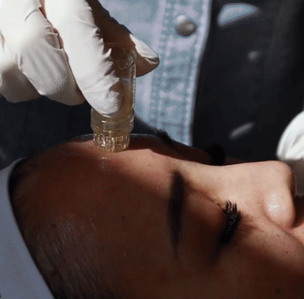 Kelsea Ballerini microneedling treatment