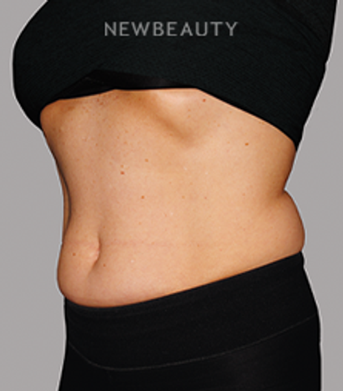Dr. Linda Honet - CoolSculpting - 22404225 - After