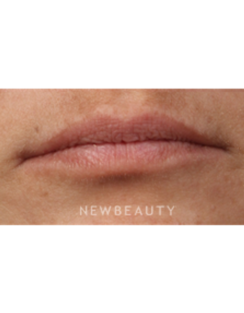 Dr. Kathleen Behr - Lip Filler - Before