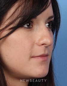 Dr. Kelly Bomer – Rhinoplasty - Before