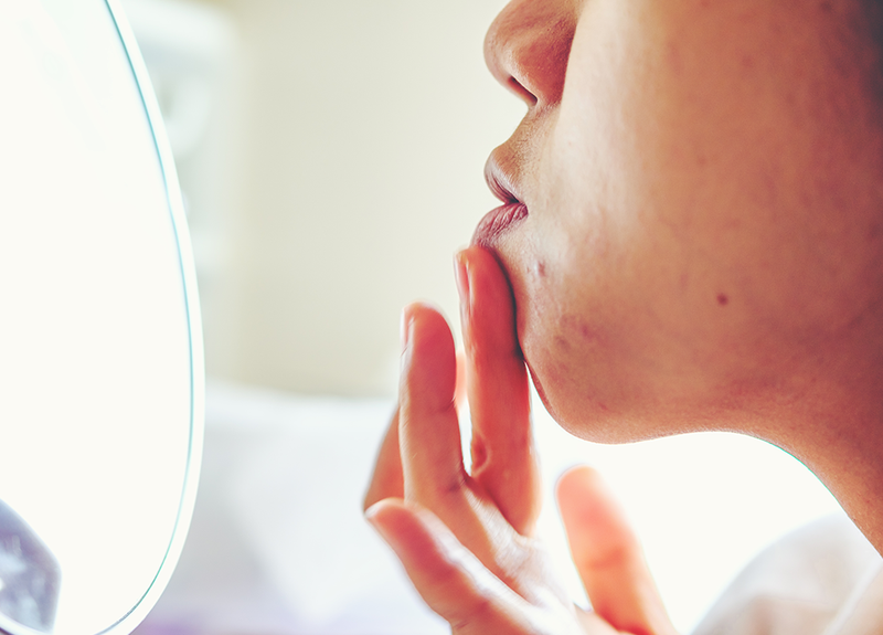 Is This New Injectable Treatment the Answer to Acne Scars?