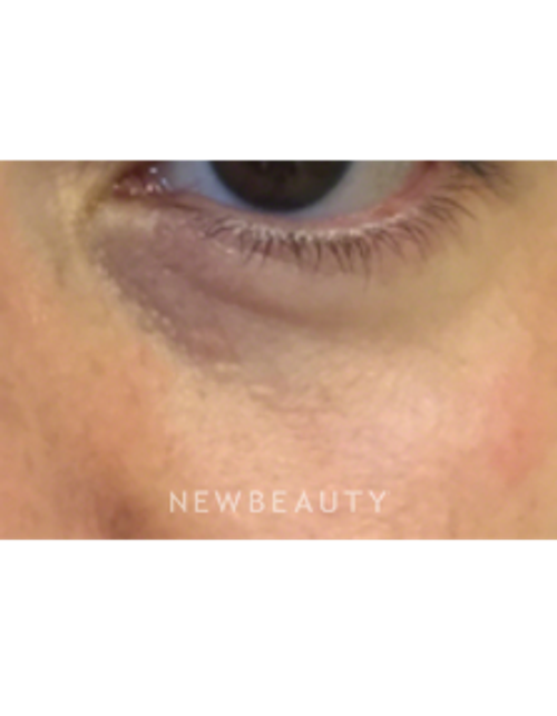 Dr. Kally Papantoniou - Injectables and Fillers - Before