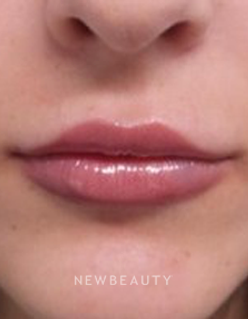 Dr. Marina Peredo - Restylane Silk - After