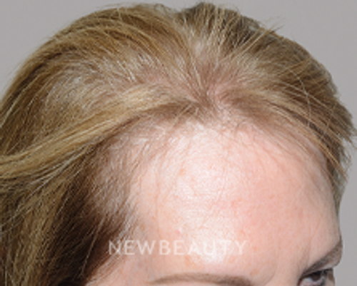 Dr. Jeffrey Epstein - Revived Tresses - 44714605 - Before