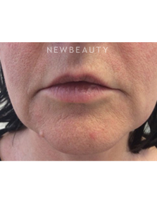 Dr. Julie Russak - Defining Beauty - Before