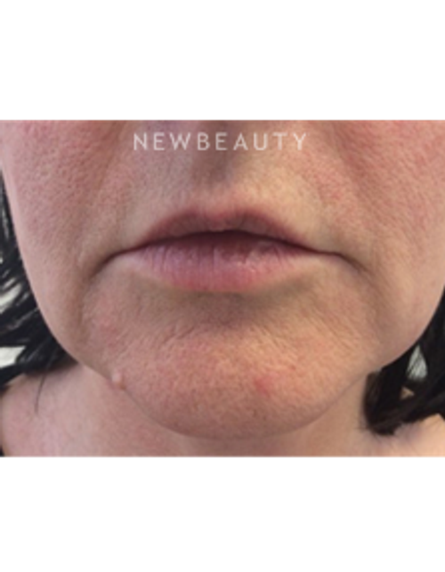 Dr. Julie Russak - Defining Beauty - Before