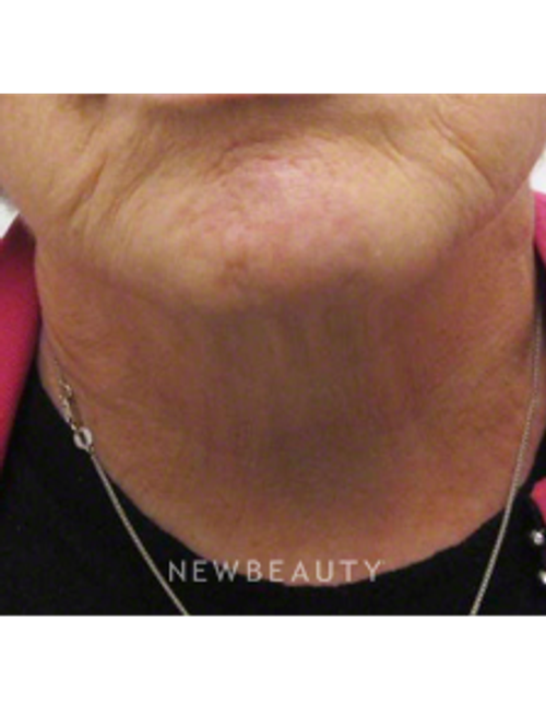 Dr. Kally Papantoniou - Ulthera - After